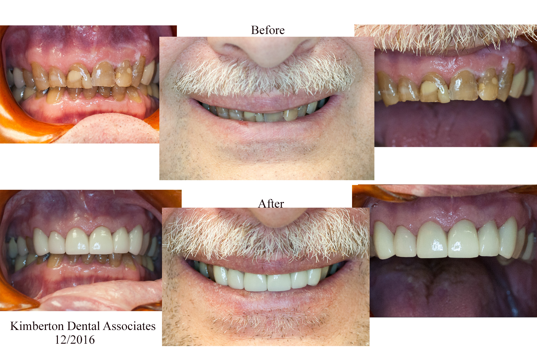 Gallery Before and after full smile restoration with dental crowns at Kimberton Dental Associates in Phoenixville, PA
