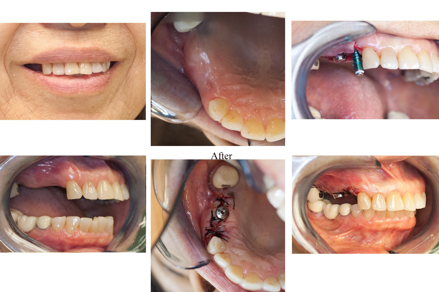 Gallery Before and after dental implant placement to replace missing upper teeth at Kimberton Dental Associates in Phoenixville, PA