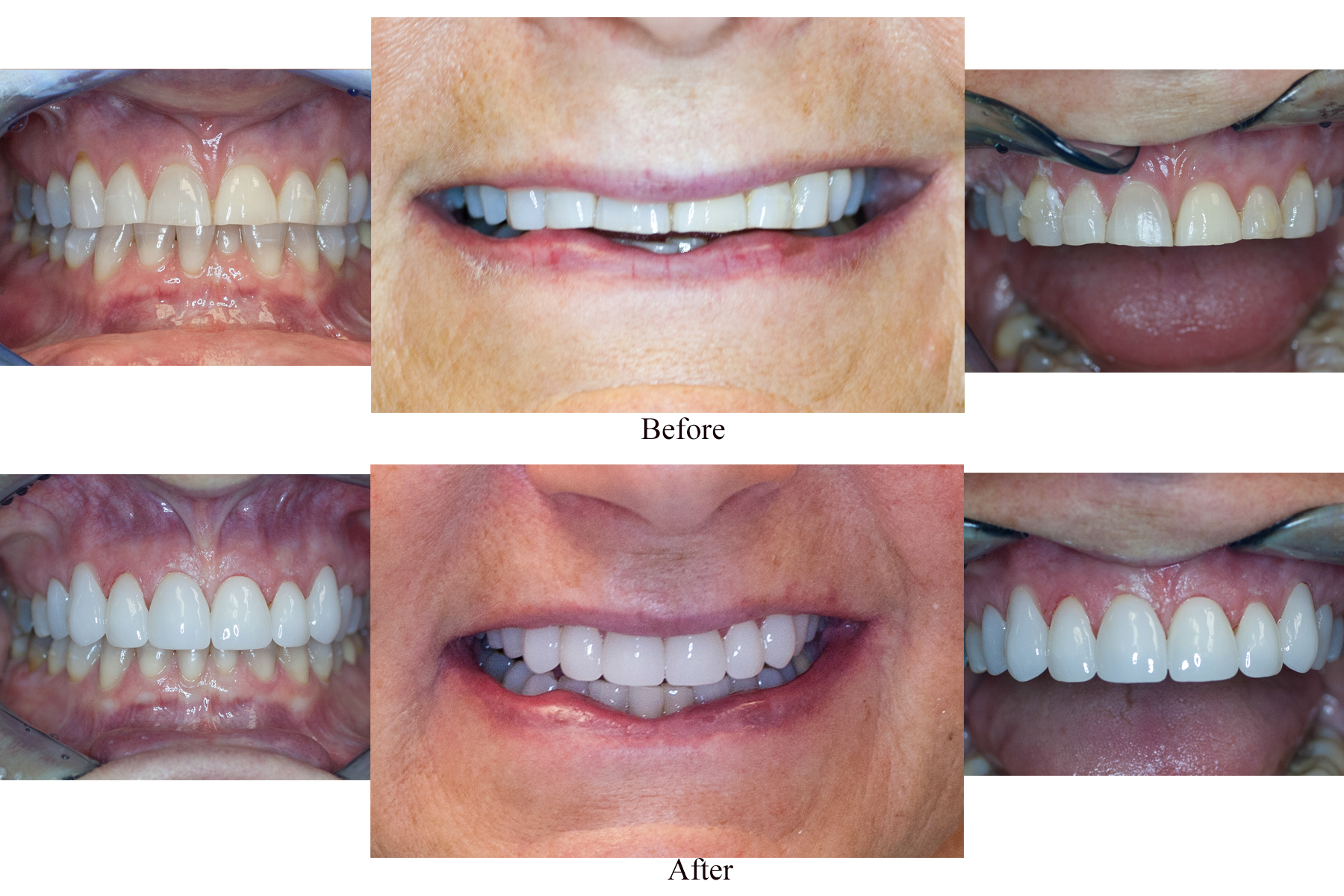Gallery Before and after cosmetic smile makeover with restored front teeth at Kimberton Dental Associates in Phoenixville, PA